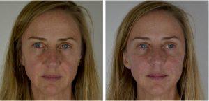 Botox Injection By Dr. Chuma Chike-Obi, Plastic Surgeon In Austin, Texas