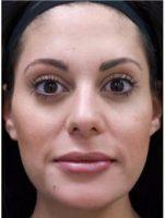 Botox Injection For Forehead Lines, Frown Lines, And Crow's Feet By Doctor Shaun Patel, MD, Miami Physician