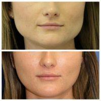 Botox Injection Treatment Images Results With Dr. Justin Harper, Miami Plastic Surgeon