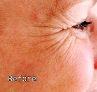 Botox Injections Are Most Popular As An Anti Aging Treatment To Get Rid Of Crows Feet