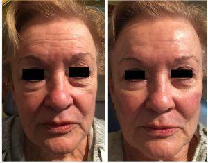 Botox Injections At Just Face It MedSpa, Medical Spa In The Clark County, Nevada (5)