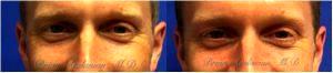 Botox Injections Before And After By Dr. Brian Arslanian, Plastic Surgeon In Atlanta, GA (1)
