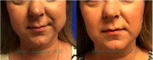 Botox Injections Before And After By Dr. Brian Arslanian, Plastic Surgeon In Atlanta, GA (2)