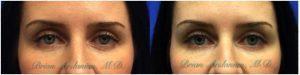 Botox Injections Before And After By Dr. Brian Arslanian, Plastic Surgeon In Atlanta, GA (3)