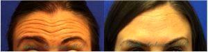 Botox Injections Before And After By Dr. Brian Arslanian, Plastic Surgeon In Atlanta, GA (4)