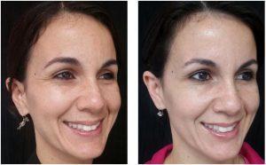 Botox Injections Before And After By Dr. Joshua Lampert, MD,FACS, Miami FL Plastic Surgeon (1)