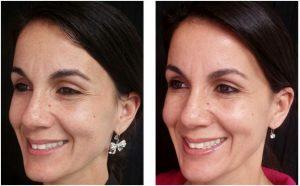 Botox Injections Before And After By Dr. Joshua Lampert, MD,FACS, Miami FL Plastic Surgeon (3)