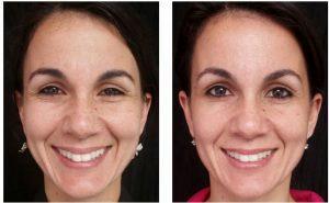 Botox Injections Before And After By Dr. Joshua Lampert, MD,FACS, Miami FL Plastic Surgeon (5)