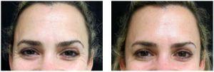 Botox Injections Before And After By Dr. Joshua Lampert, MD,FACS, Miami FL Plastic Surgeon (7)