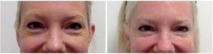 Botox Injections Before And After By Onna Feuchter, Injector, Skin, And Laser Specialist In Southlake, Texas (1)