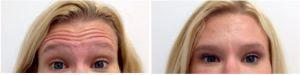Botox Injections Before And After By Onna Feuchter, Injector, Skin, And Laser Specialist In Southlake, Texas (3)