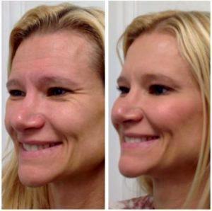 Botox Injections Before And After By Onna Feuchter, Injector, Skin, And Laser Specialist In Southlake, Texas (4)