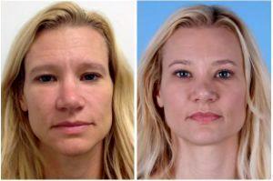 Botox Injections Before And After By Onna Feuchter, Injector, Skin, And Laser Specialist In Southlake, Texas (5)