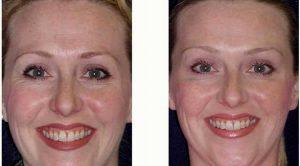 Botox Injections By Dr Anna Petropoulos, MD, FRCS, Boston Facial Plastic Surgeon