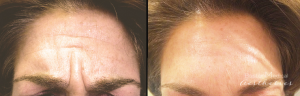 Botox Injections By JENNIFER CANESI, APN-BC, Board Certified Adult Nurse Practitioner In Boston