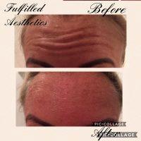 Botox Injections Can Be Used On Several Areas Of The Face And Neck With Great Results