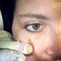 Botox Injections For Bags Under Eyes