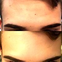Botox Injections For Forehead Before And After