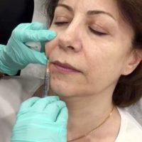 Botox Injections For Marionette Lines