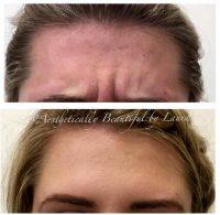 Botox Injections For Vertical Frown Lines