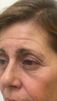 Botox Injections Image Result By Doctor Jean Keamy, Boston Plastic Surgeon