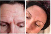 Botox Injections Is A Way For Many Patients To Change The Way Their Face Looks