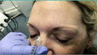 Botox Injections Permanently Remove Frown Lines