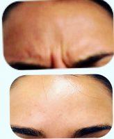 Botox Injections Works For Dynamic Lines Created By Movement
