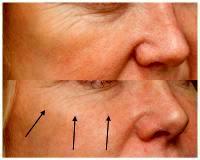 Botox Is A Trusted Way Of Getting Rid Of Crow's Feet