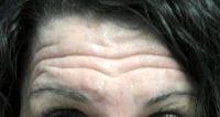 Botox Is Also Used To Control Facial Muscle Spasms And Tics