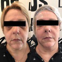 Botox Is Designed To Erase Fine Lines And Wrinkles To Create A More Youthful Appearance