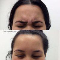 Botox Is Most Commonly Used On The Wrinkles Between The Eyebrows