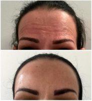 Botox Is Not Effective On Wrinkles That Are Visible When The Face Is At Rest
