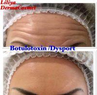 Botox Is The Brand Name Of The Formula Containing Clostridium Botulinum