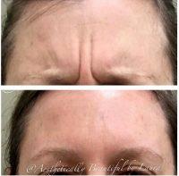 Botox Is The Other Popular Solution In Getting Rid Of Lines On Forehead