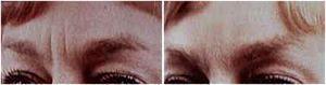 Botox Is Very Effective For The Frown Muscled Between The Eyebrows - By Boston Plastic Surgeon, Dr. Daniel Del Vecchio