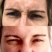 Botox Is Very Effective When Used For Dynamic Wrinkles