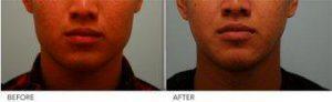 Botox Jaw Reduction With Doctor Sam Lam, MD, FACS, Dallas Facial Plastic Surgeon