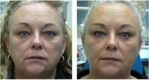 Botox, Juvederm And Radiesse By Dr. Christine Hamori, Plastic Surgeon In Duxbury, MA