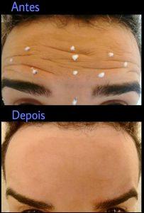Botox Lines In Forehead Before And After (1)