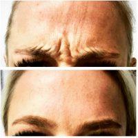 Botox Or Dysport Can Be Used To Soften The Deepening Of The Frown Lines