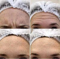 Botox Or Laser On Forehead Creases