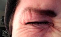 Botox Plastic Surgery For Crows Feet By Dr Richard Ort, Denver Plastic Surgeon