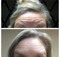 Botox Remove Forehead Lines