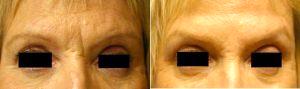 Botox & Restylane Together - Glabella With Dr. Kenneth Beer, MD, Palm Beach Dermatologic Surgeon