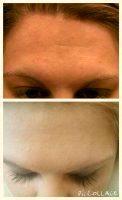 Botox Results Are Visible Within One Week After Treatment