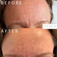 Botox Results For Forehead Lines Before And After