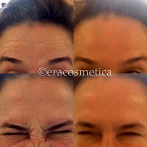 Botox Results Forehead Lines (1)