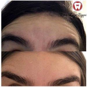 Botox Results Forehead Lines (2)