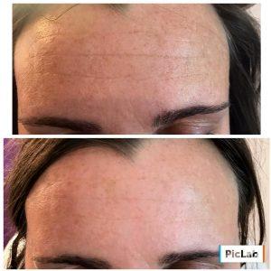 Botox Results Forehead Lines (3)